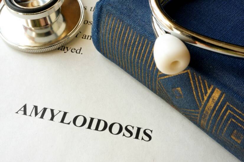 Amyloidoza: czym jest i dlaczego powstaje, jakie ma objawy?