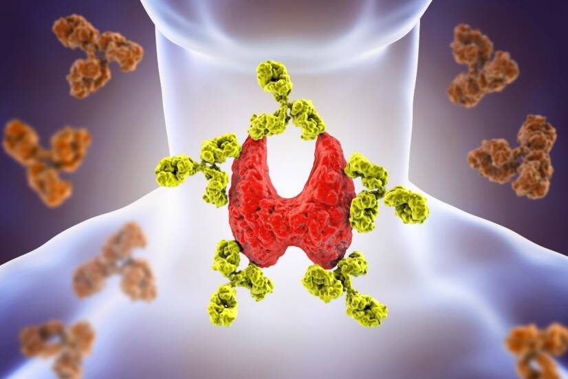 Autoimmunologiczne zapalenie tarczycy: choroba Hashimoto - przyczyny, objawy