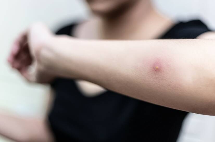 Ropień skóry: co to jest, jakie są przyczyny i objawy infekcji skóry?
