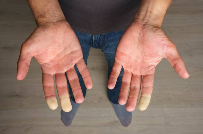 Zespół Raynauda: co jest przyczyną drętwienia palców?