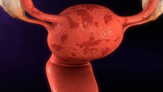Związek między endometriozą a niepłodnością + Inne objawy i problemy zdrowotne