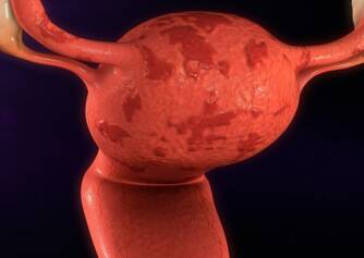 Związek między endometriozą a niepłodnością + Inne objawy i problemy zdrowotne