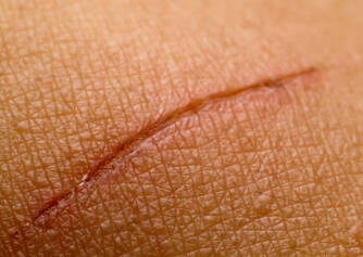 Powolne gojenie się ran: jakie są jego przyczyny (+ czynniki ryzyka)