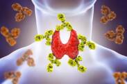 Autoimmunologiczne zapalenie tarczycy: choroba Hashimoto - przyczyny, objawy