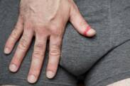 Stulejka i parafimoza (zwężenie napletka): jakie są jej przyczyny i objawy?