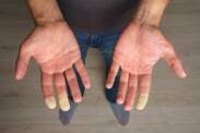 Zespół Raynauda: co jest przyczyną drętwienia palców?