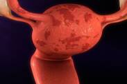 Związek między endometriozą a niepłodnością + Inne objawy i problemy zdrowotne