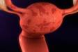 Związek między endometriozą a niepłodnością + Inne objawy i problemy zdrowotne